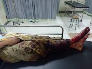 Detik-detik Jari Tangan, Kaki dan Wajah Pemuda di Ponorogo Hancur Terkena Petasan