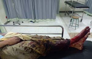 Detik-detik Jari Tangan, Kaki dan Wajah Pemuda di Ponorogo Hancur Terkena Petasan